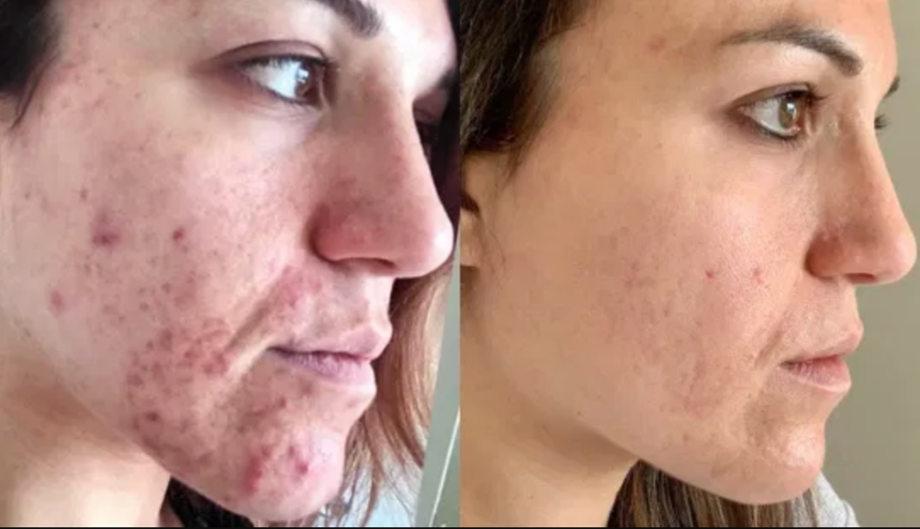 Does Proactive make acne worse?