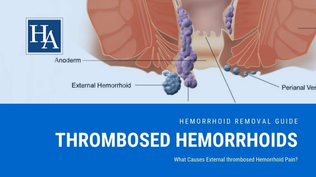 How long does it take for a hemorrhoid to go away with Preparation H?